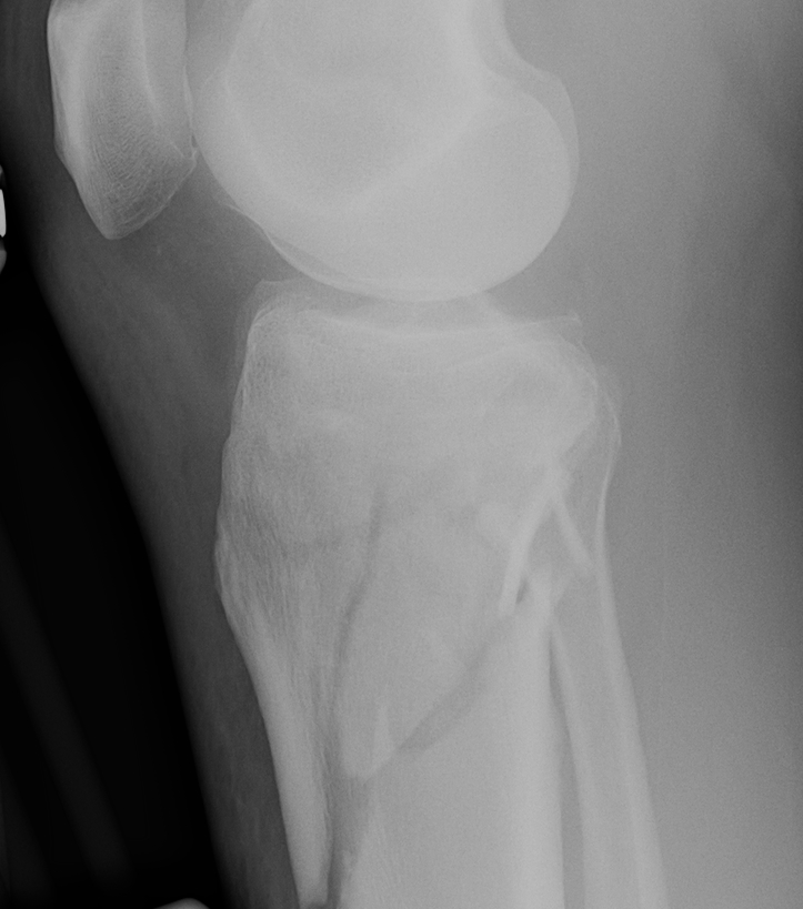 Tibial Plateau Temporary External Fixator Lateral